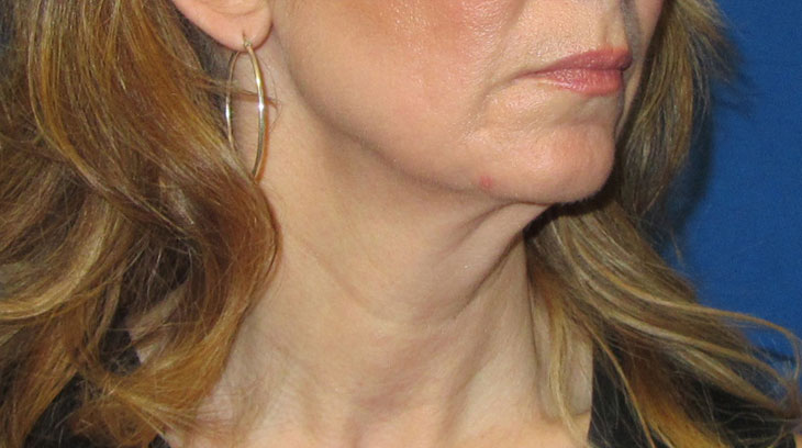 Neck Lift Before & After Photo #9