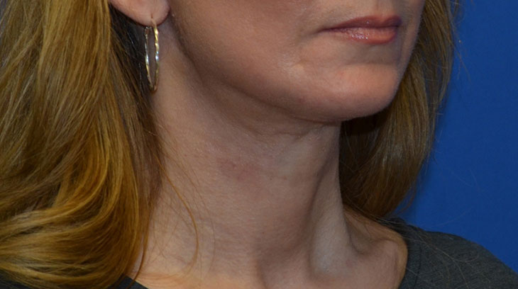 Neck Lift Before & After Photo #10