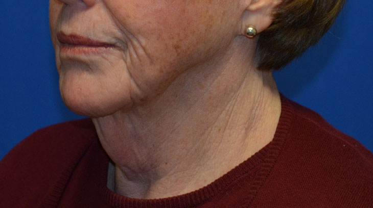 Neck Lift Before & After Photo #5