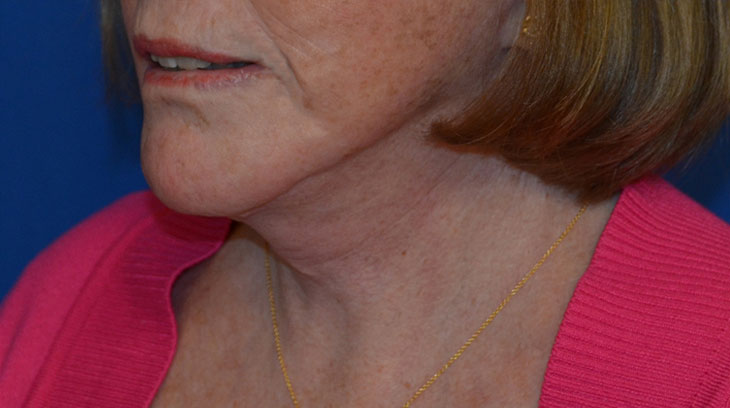 Neck Lift Before & After Photo #6