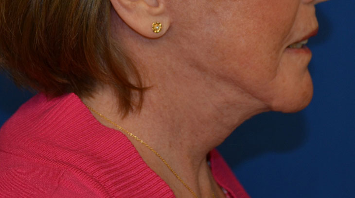 Neck Lift Before & After Photo #8