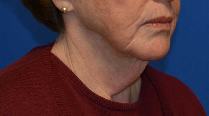 Neck Lift Before & After Photo #9