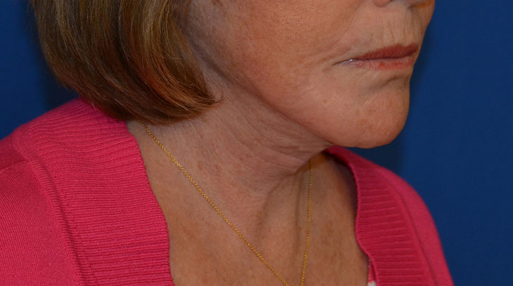 Neck Lift Before & After Photo #10