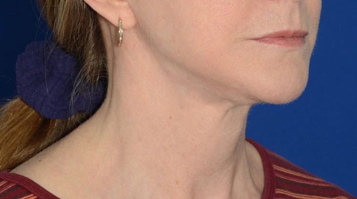 Neck Lift Before & After Photo #10