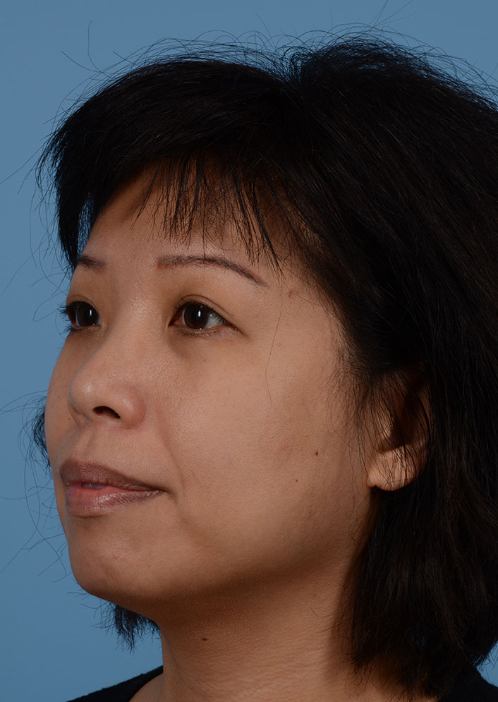 Non Surgical Chin Augmentation Before & After Photo #1