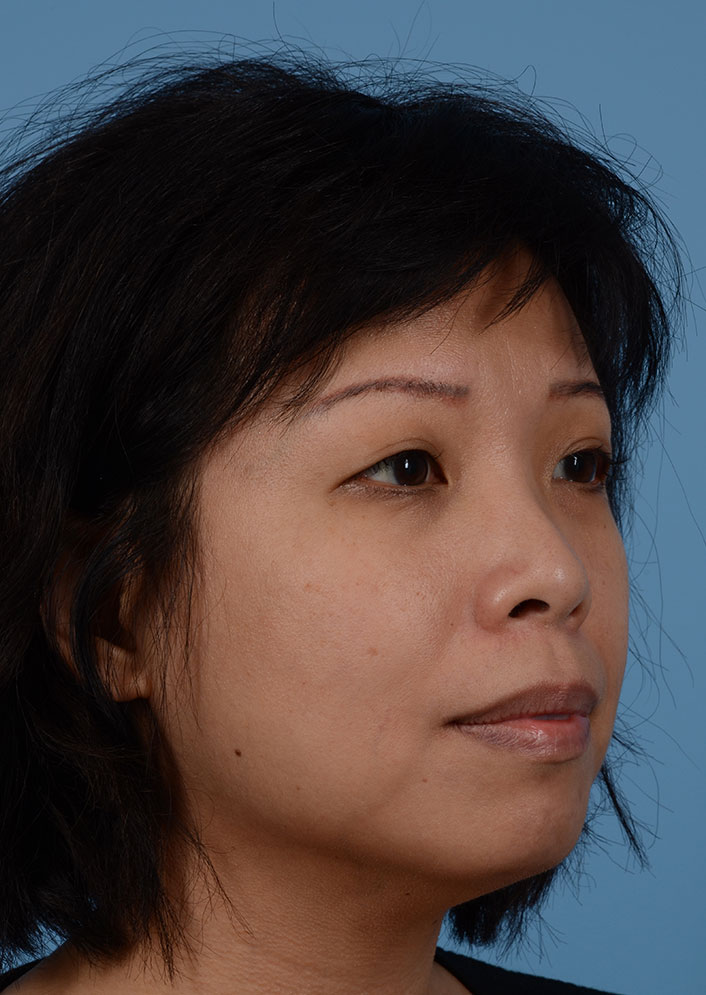 Non Surgical Chin Augmentation Before & After Photo #5