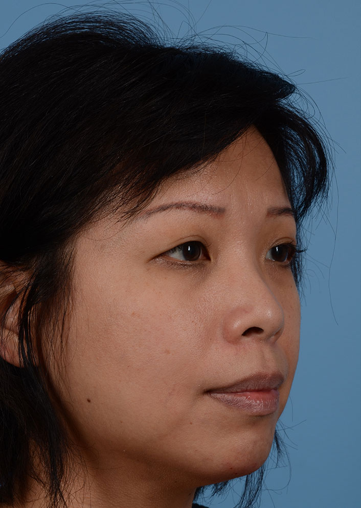 Non Surgical Chin Augmentation Before & After Photo #6