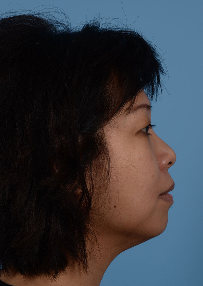 Non Surgical Chin Augmentation Before & After Photo #7