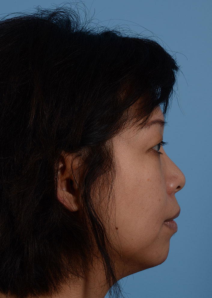 Non Surgical Chin Augmentation Before & After Photo #8