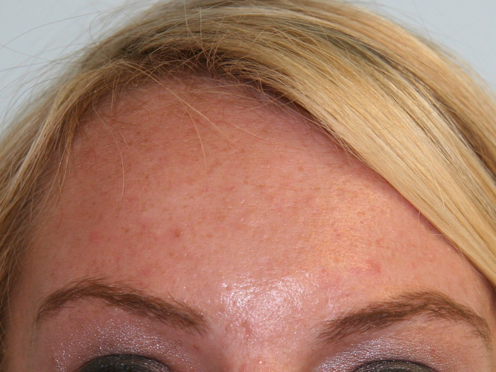 Pediatric Before & After Photo #2