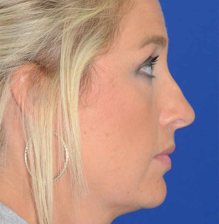 Rhinoplasty Before & After Photo #7