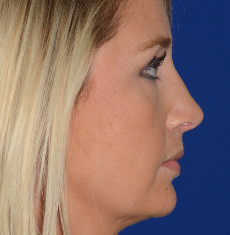 Rhinoplasty Before & After Photo #8