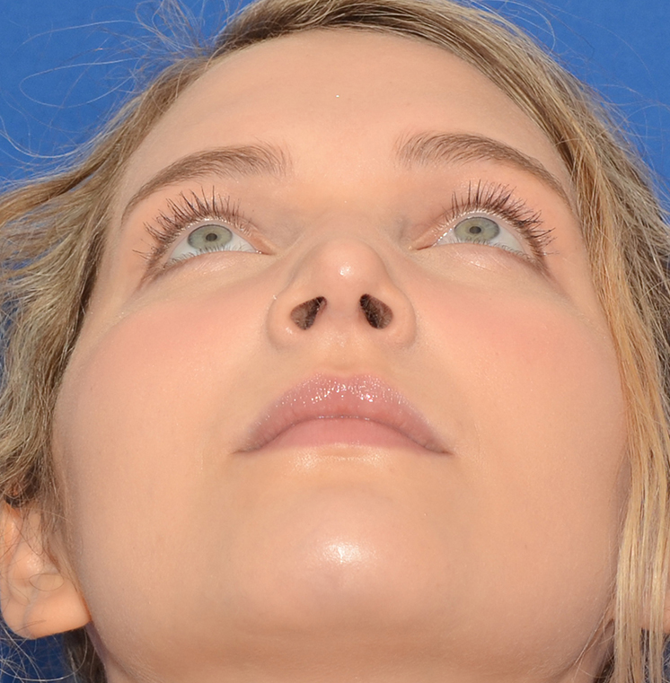 Rhinoplasty Before & After Photo #4