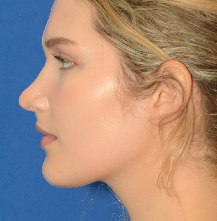 Rhinoplasty Before & After Photo #8