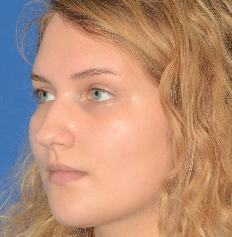 Rhinoplasty Before & After Photo #9