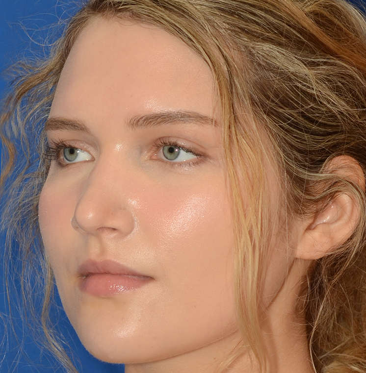 Rhinoplasty Before & After Photo #10