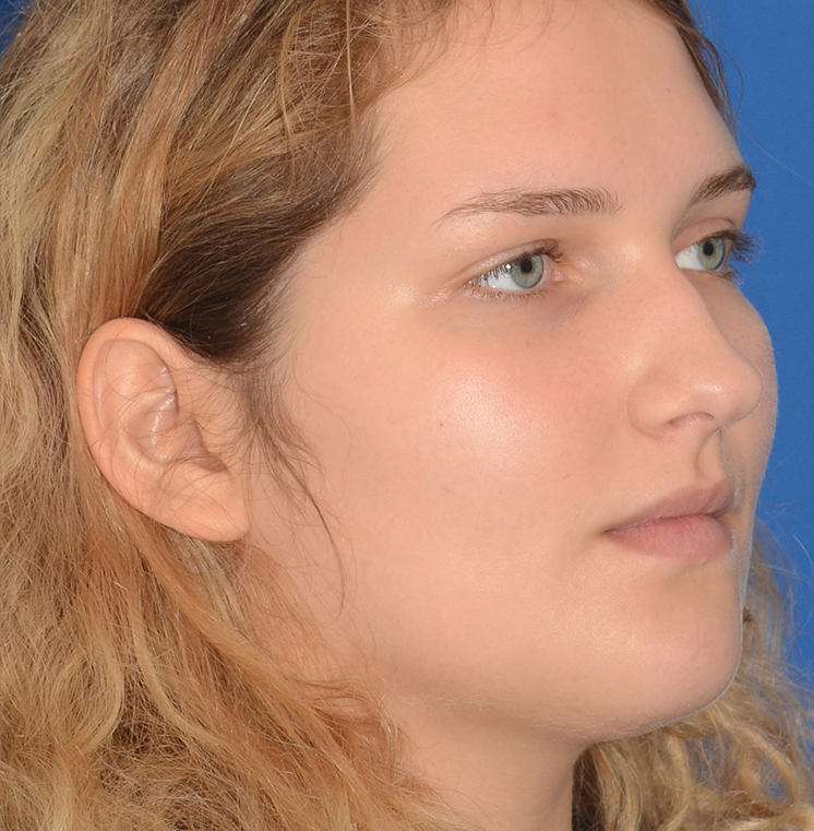 Rhinoplasty Before & After Photo #13