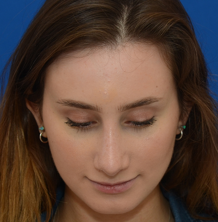 Rhinoplasty Before & After Photo #6