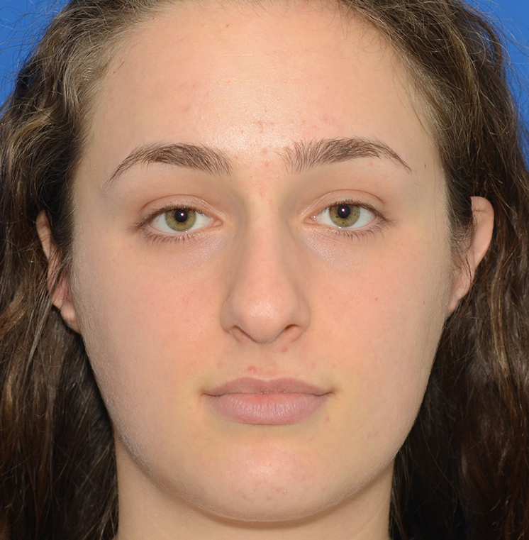 Rhinoplasty Before & After Photo #1