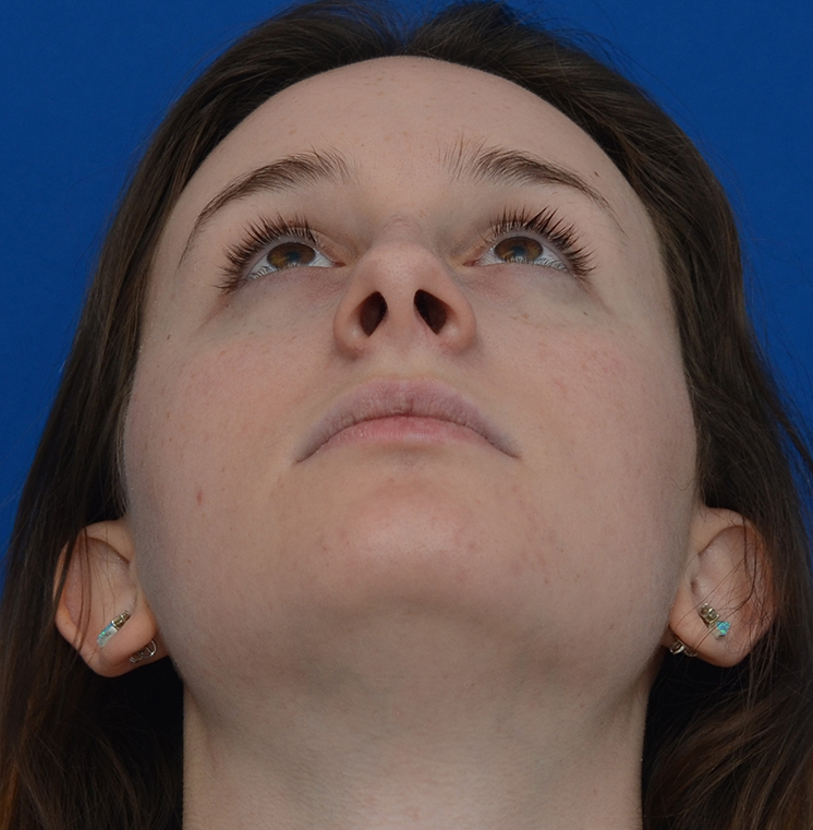 Rhinoplasty Before & After Photo #3