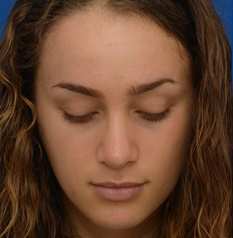 Rhinoplasty Before & After Photo #6