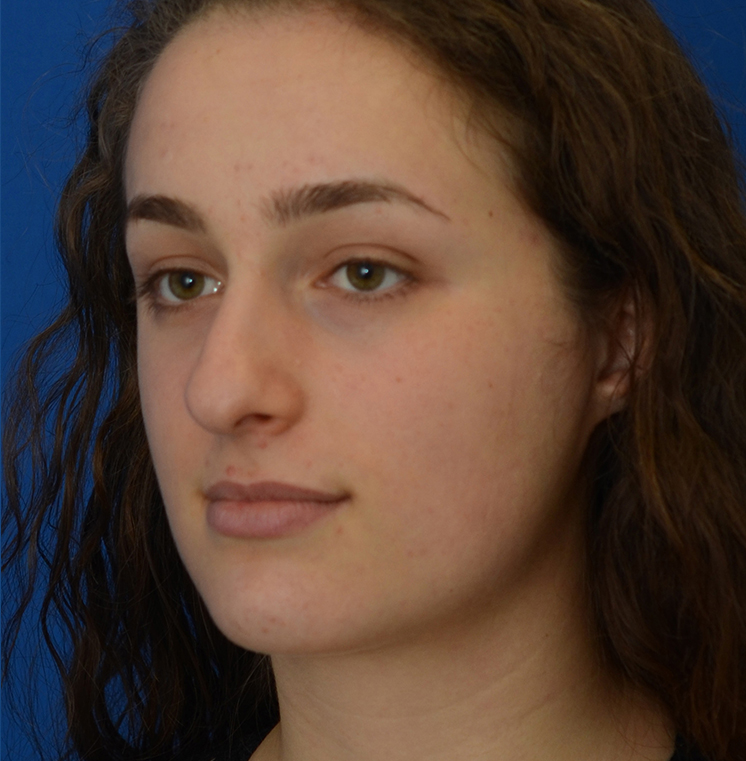 Rhinoplasty Before & After Photo #9