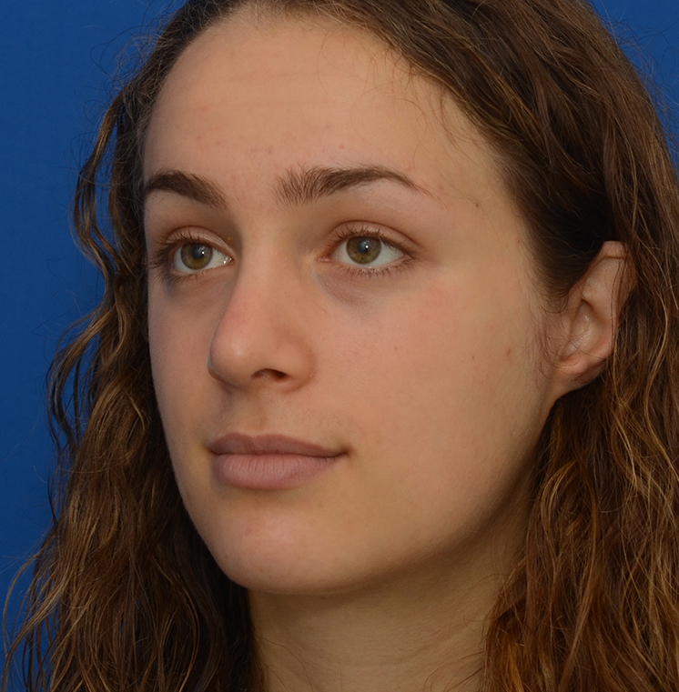 Rhinoplasty Before & After Photo #10