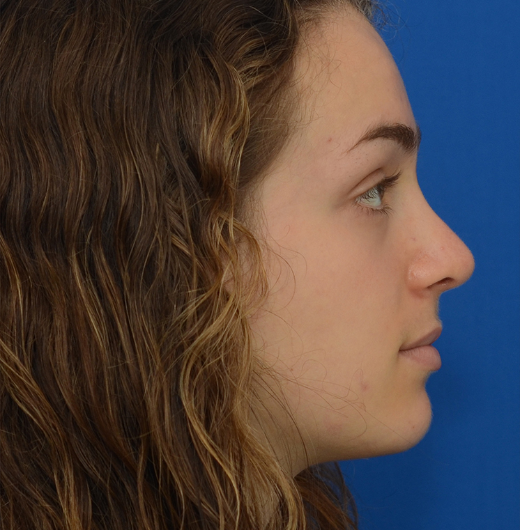 Rhinoplasty Before & After Photo #12