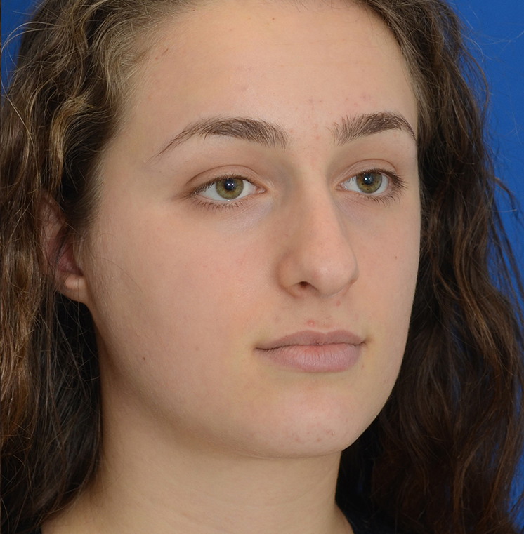 Rhinoplasty Before & After Photo #13