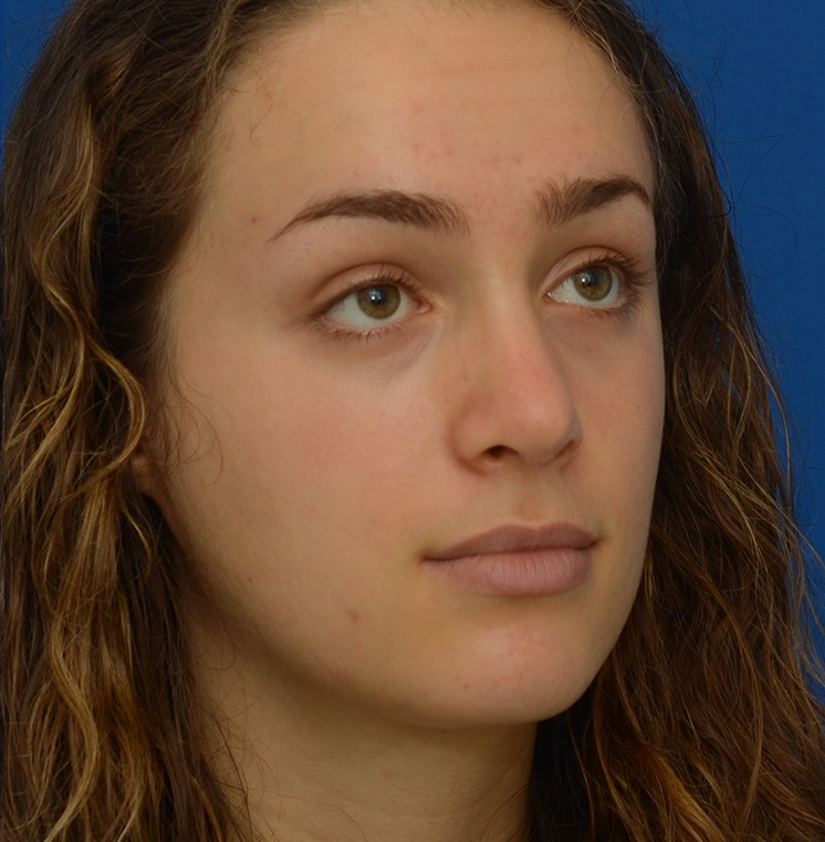Rhinoplasty Before & After Photo #14