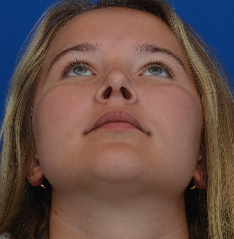 Rhinoplasty Before & After Photo #4