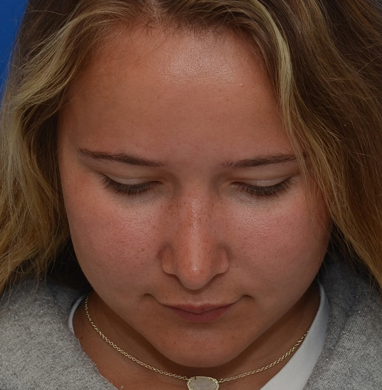 Rhinoplasty Before & After Photo #6