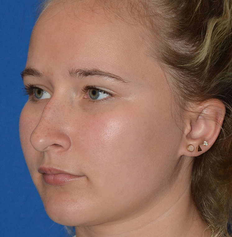 Rhinoplasty Before & After Photo #9