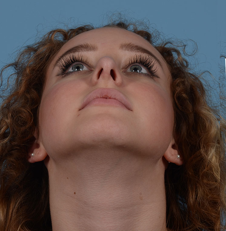Rhinoplasty Before & After Photo #4