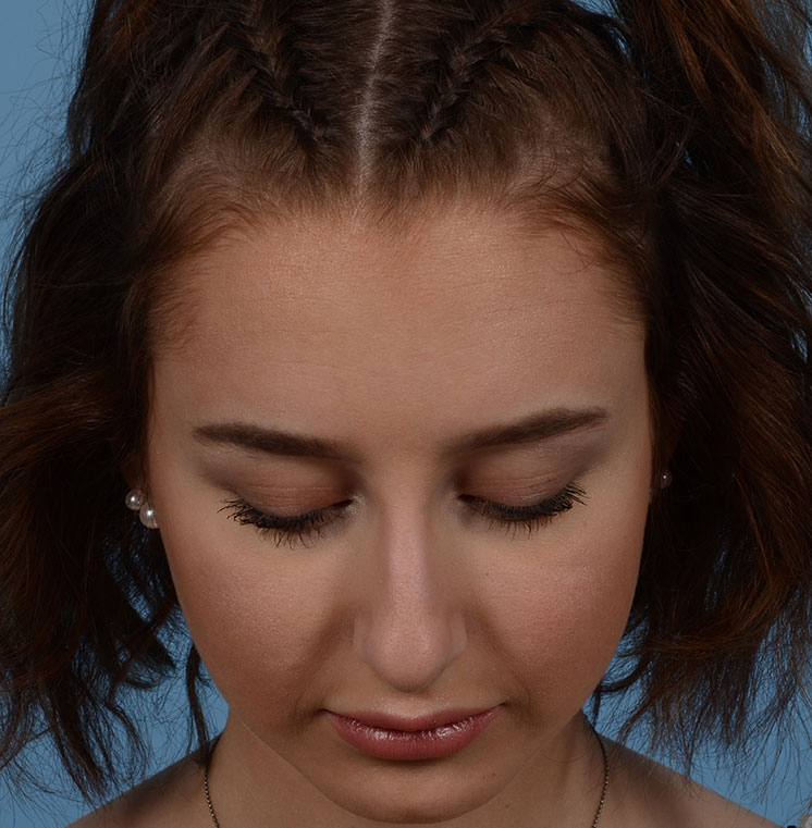 Rhinoplasty Before & After Photo #5