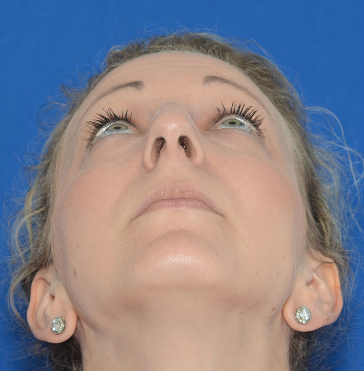 Rhinoplasty Before & After Photo #3