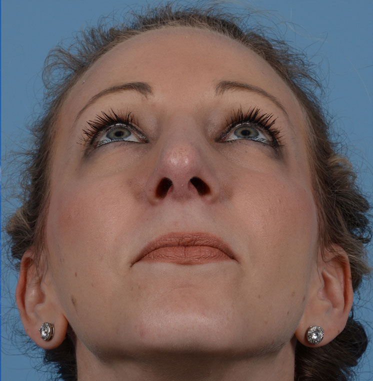 Rhinoplasty Before & After Photo #4