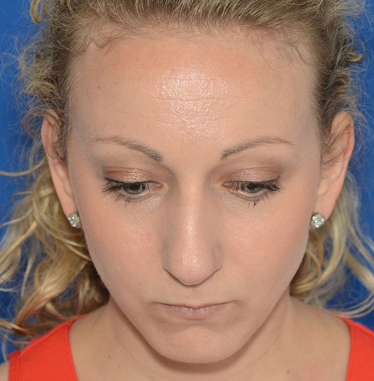 Rhinoplasty Before & After Photo #5