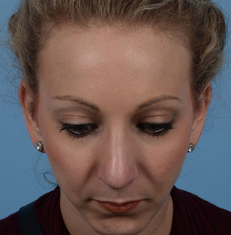 Rhinoplasty Before & After Photo #6