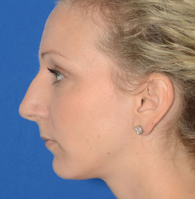 Rhinoplasty Before & After Photo #7