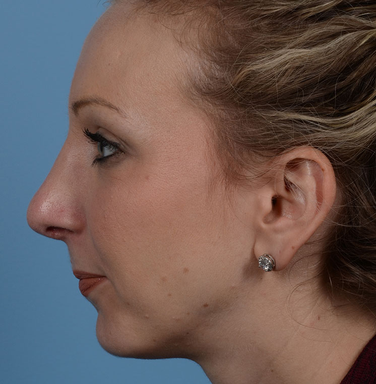 Rhinoplasty Before & After Photo #8