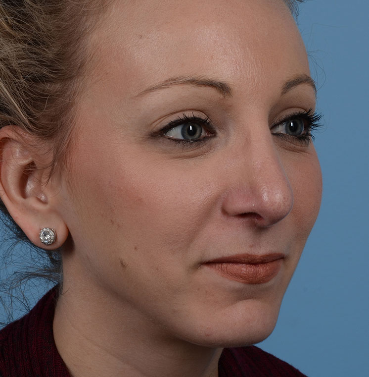 Rhinoplasty Before & After Photo #10