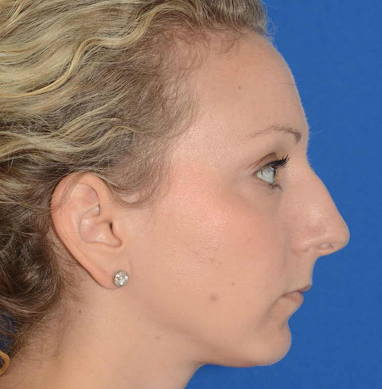 Rhinoplasty Before & After Photo #11