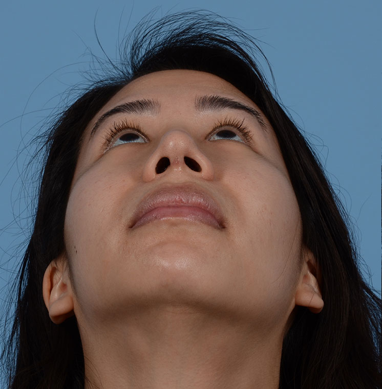 Rhinoplasty Before & After Photo #4