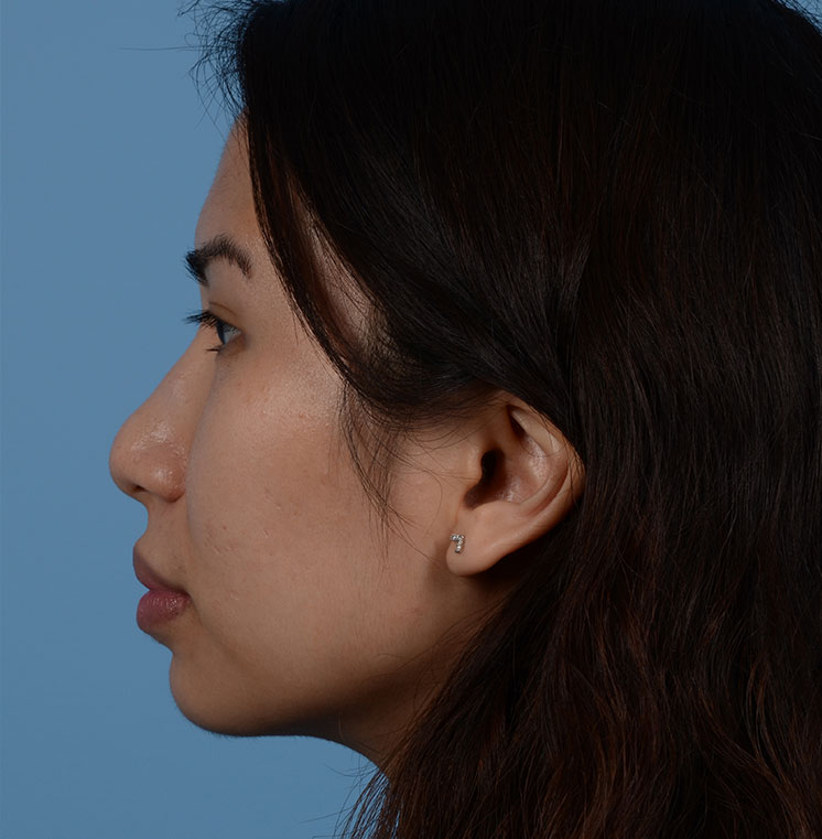 Rhinoplasty Before & After Photo #9