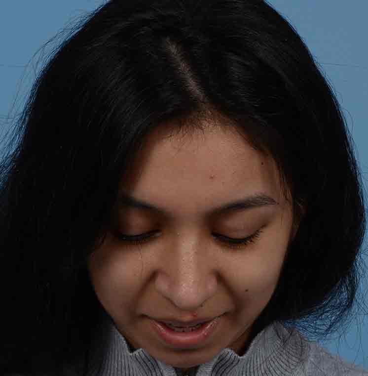 Rhinoplasty Before & After Photo #6
