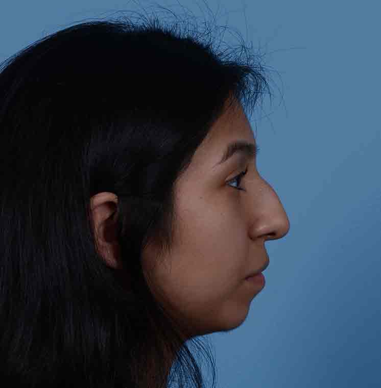 Rhinoplasty Before & After Photo #13