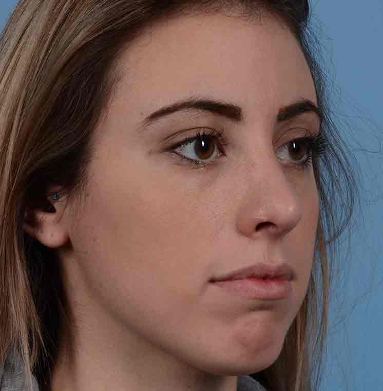 Rhinoplasty Before & After Photo #12
