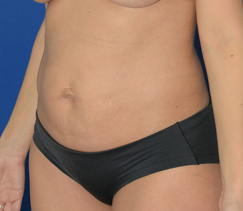 Tummy Tuck Before & After Photo #5